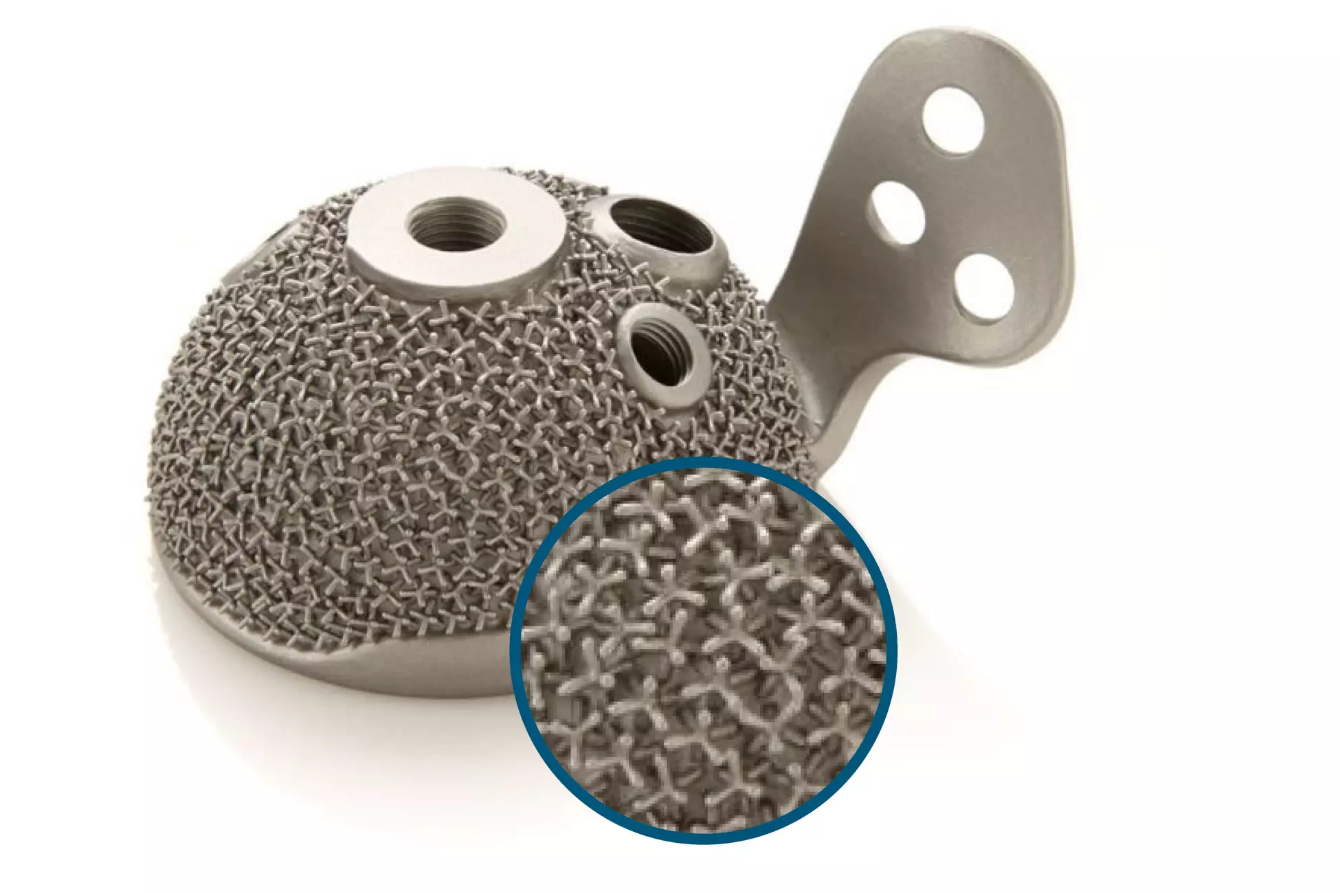 cupules acétabulaires impression 3D cire perdue